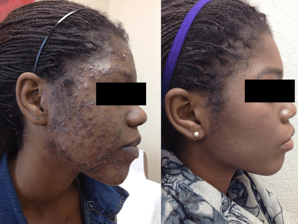 acne treatment before and after