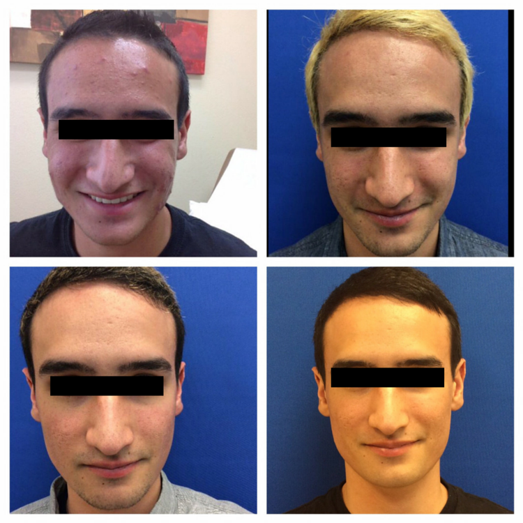 before after acne treatment accutane resurfacing