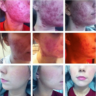 acne before and after