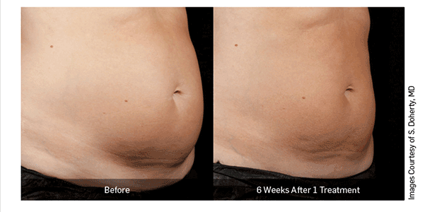 Cyno-SculpSure-eblast-12