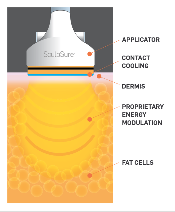 SculpSure-MOA-Still-1024x716