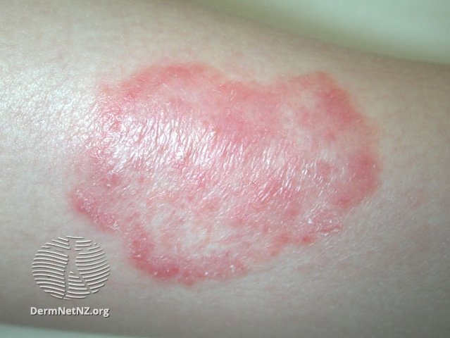 red scaly rash