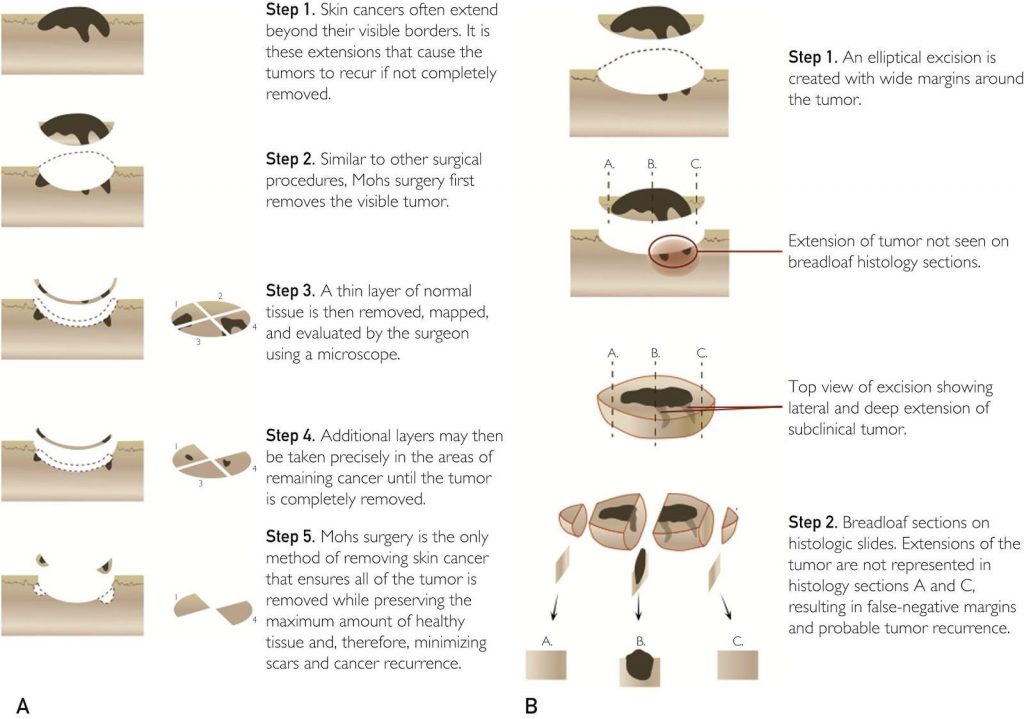 MOHS surgery