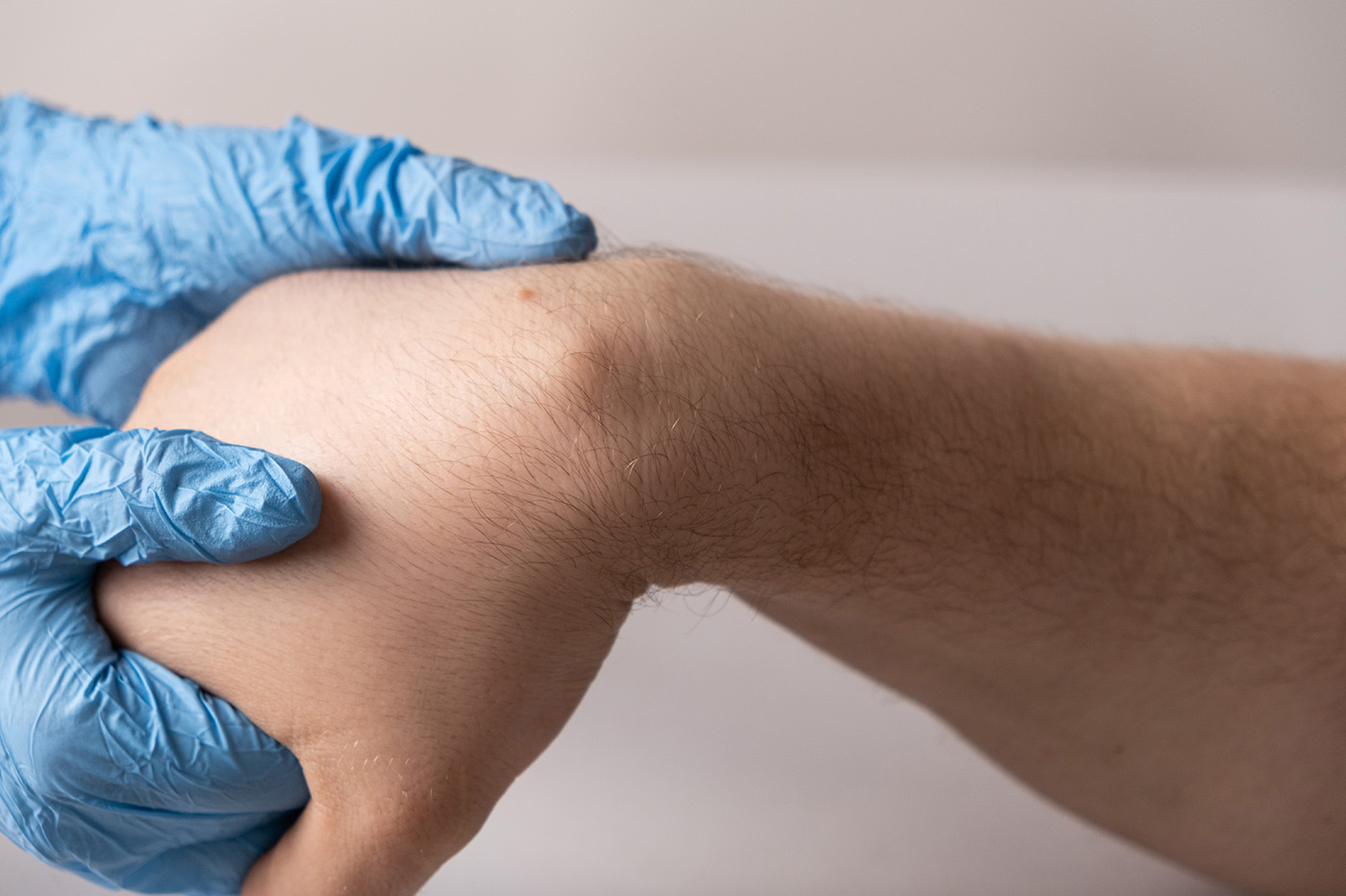 lipoma removal