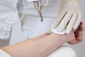 tattoo removal
